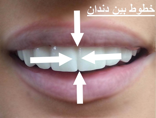 خطوط بین دندان