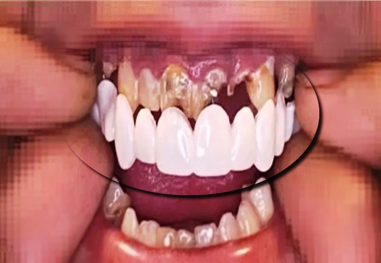 عکس لمینت تمام متحرک دندان اسنپ آن اسمایل